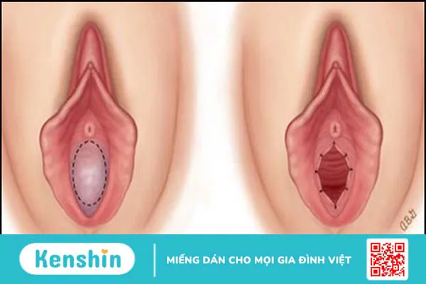 Màng trinh: vị trí, hình thành cấu tạo, và những điều bạn nên biết