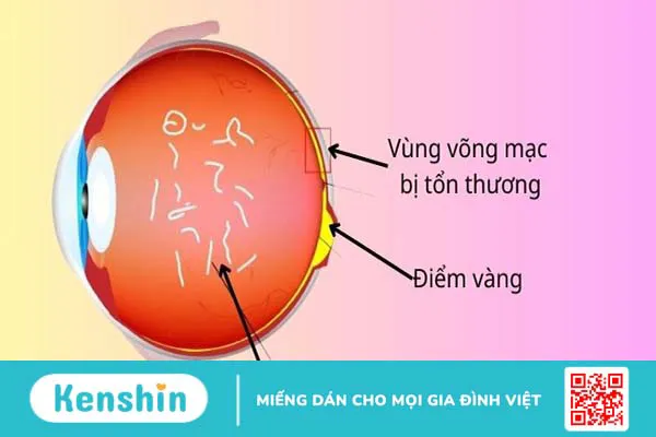 Mắt nhìn thấy đốm sáng là gì? Nguyên nhân và cách phòng tránh