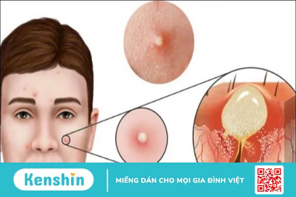 Mật ong Manuka là gì? 12 tác dụng của Manuka với sức khỏe