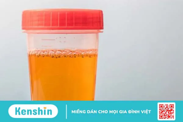 Màu nước tiểu nói lên điều gì về sức khỏe của bạn?