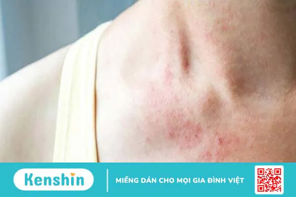 Men gạo đỏ là gì? Tác dụng, cách dùng, lưu ý khi sử dụng