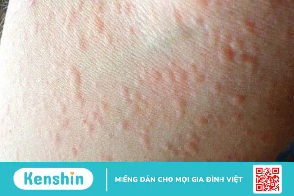 Menthol giảm đau khớp như thế nào?