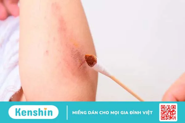 Mèo cắn, cào chảy máu có bị bệnh dại không? Cách xử lý vết thương