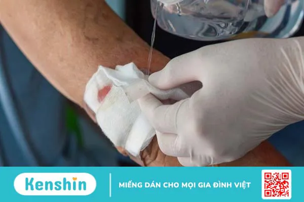 Mèo cắn, cào chảy máu có bị bệnh dại không? Cách xử lý vết thương