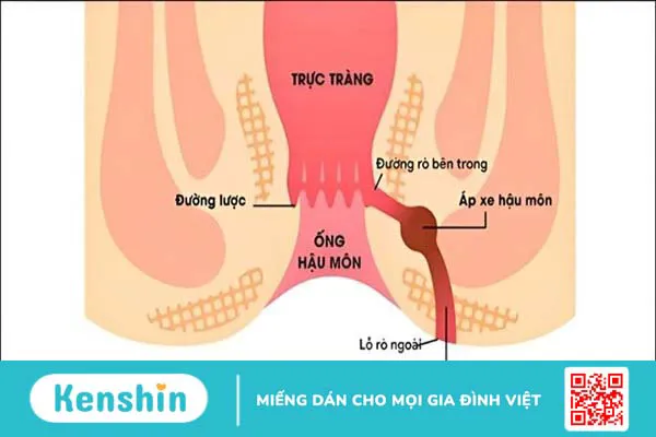 Mổ rò hậu môn bao lâu thì lành? Hướng dẫn cách chăm sóc vết mổ