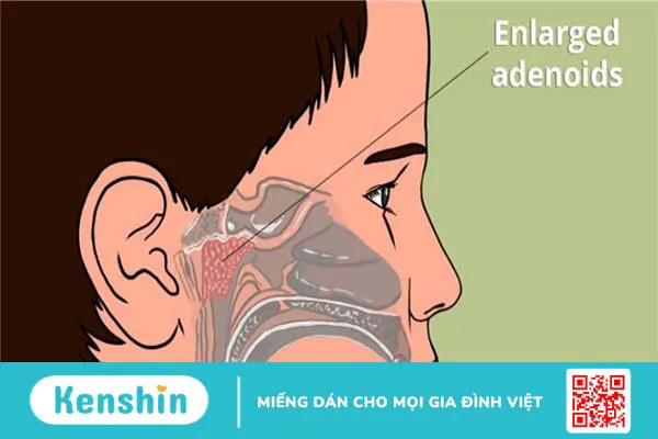 Mối liên quan giữa tai mũi họng có thể bạn chưa biết