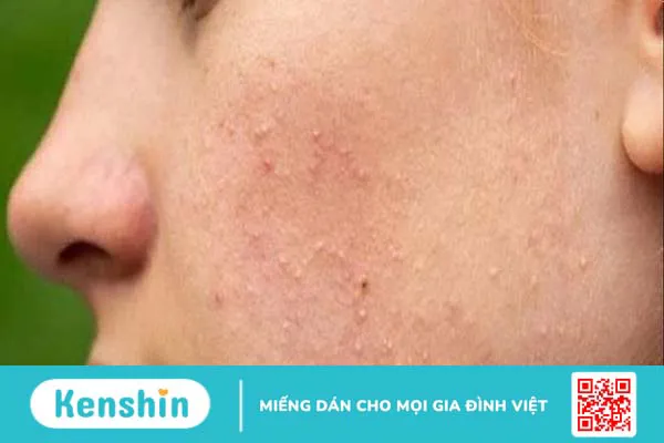 Mụn ẩn là gì? 14 cách trị mụn ẩn an toàn, hiệu quả và cách ngăn ngừa