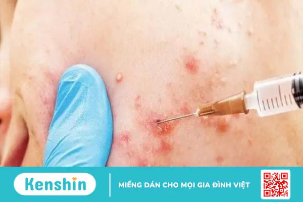 Mụn ẩn là gì? 14 cách trị mụn ẩn an toàn, hiệu quả và cách ngăn ngừa