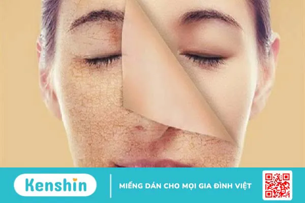 Mụn ẩn là gì? 14 cách trị mụn ẩn an toàn, hiệu quả và cách ngăn ngừa