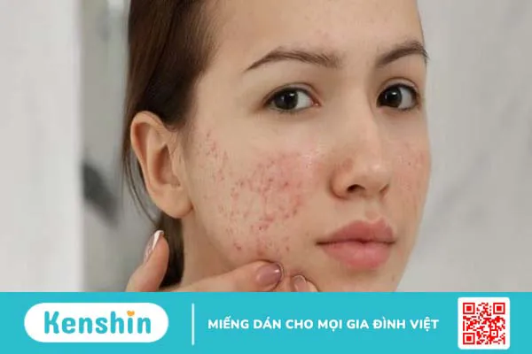 Mụn ẩn là gì? 14 cách trị mụn ẩn an toàn, hiệu quả và cách ngăn ngừa