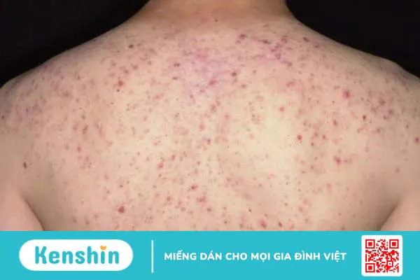 Mụn trứng cá ở tuổi dậy thì