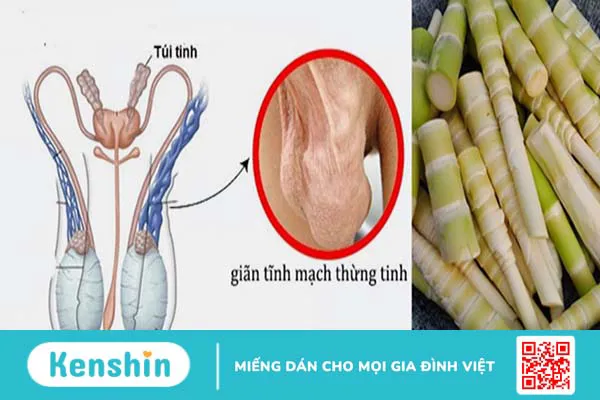 Nam giới bị giãn tĩnh mạch thừng tinh thì nên kiêng gì?