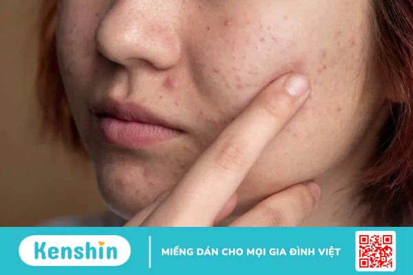 Nặn mụn xong nên làm gì để không bị thâm? Cách chăm sóc da sau nặn mụn