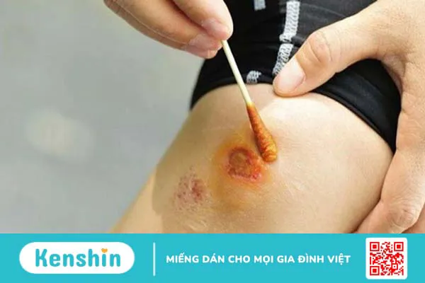 Ngộ độc botulinum là gì? Nguyên nhân, triệu chứng và cách phòng ngừa