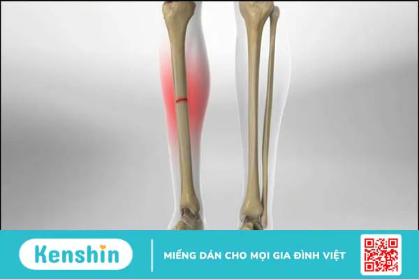 Người bị gãy xương nên ăn gì? 8 thực phẩm giúp mau lành khi bị gãy xương