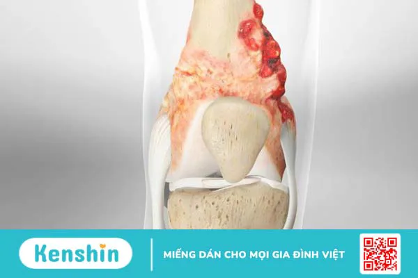 Người mắc bệnh ung thư xương sống được bao lâu?