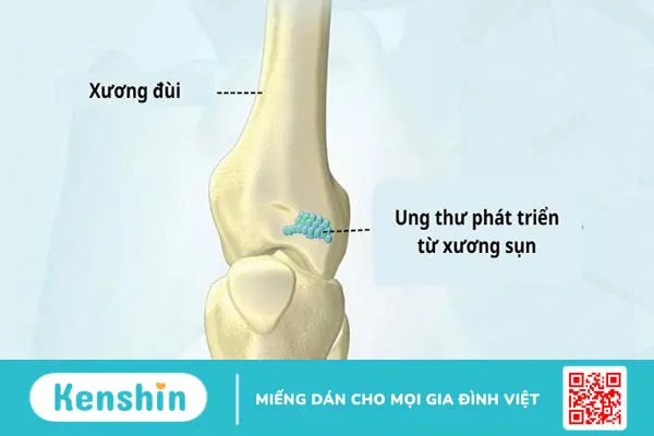 Người mắc bệnh ung thư xương sống được bao lâu?