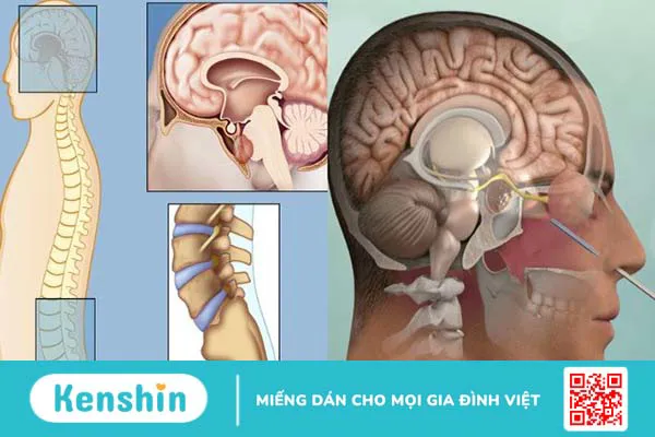 Người mắc bệnh ung thư xương sống được bao lâu?