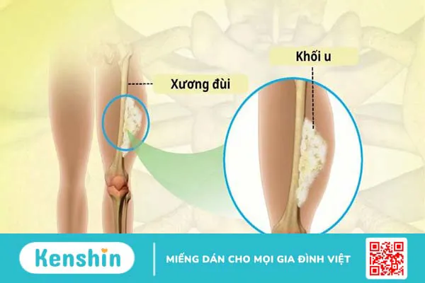 Người mắc bệnh ung thư xương sống được bao lâu?