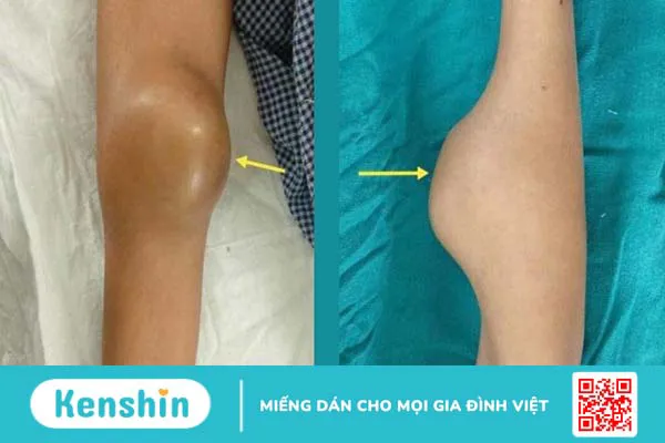 Người mắc bệnh ung thư xương sống được bao lâu?