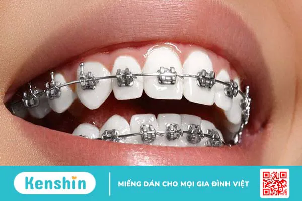 Người mới niềng răng nên ăn gì và kiêng gì? Các lưu ý trong khi niềng răng