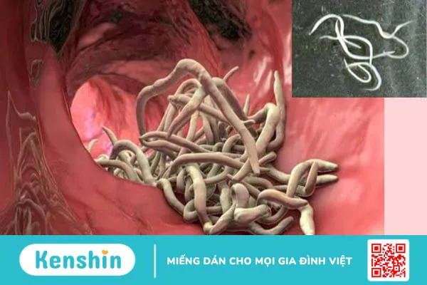 Người nhiễm giun kim sẽ bị gì? 4 dấu hiệu nhiễm giun kim bạn cần biết