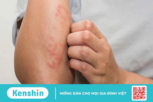 Nguyên nhân, cách nhận biết và điều trị khi dị ứng bạc hà