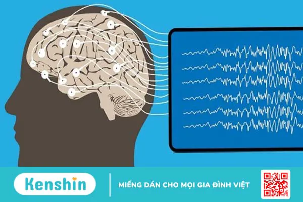 Nguyên nhân động kinh thường gặp và các yếu tố liên quan