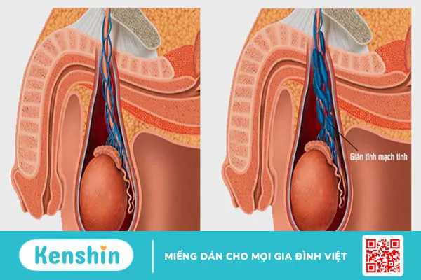 Nguyên nhân gây giãn tĩnh mạch thừng tinh và cách điều trị