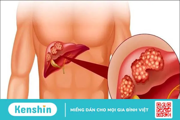 Nguyên nhân men gan cao có thể bạn chưa biết