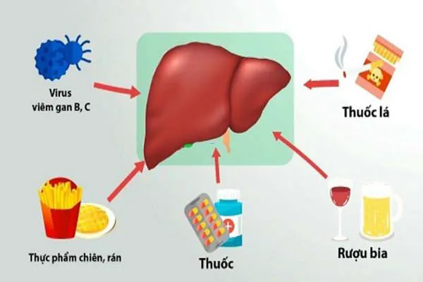 Nguyên nhân men gan cao có thể bạn chưa biết