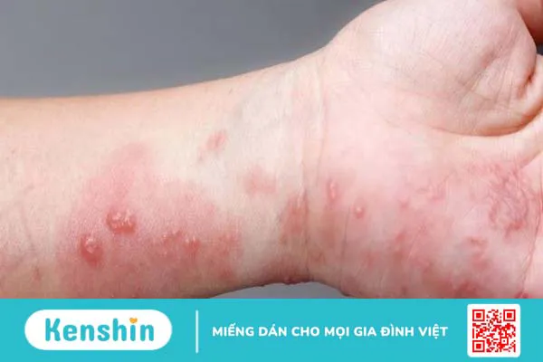 Nguyên nhân viêm bao quy đầu phổ biến có thể bạn đang gặp phải