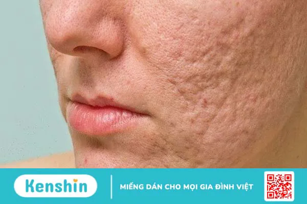 Nha đam có thể làm giảm sự xuất hiện của sẹo mụn không?