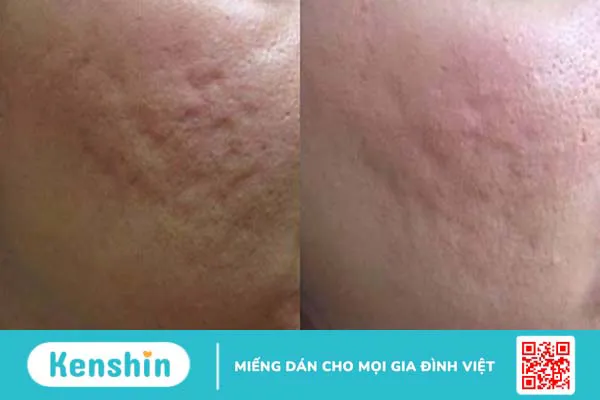 Nha đam có thể làm giảm sự xuất hiện của sẹo mụn không?