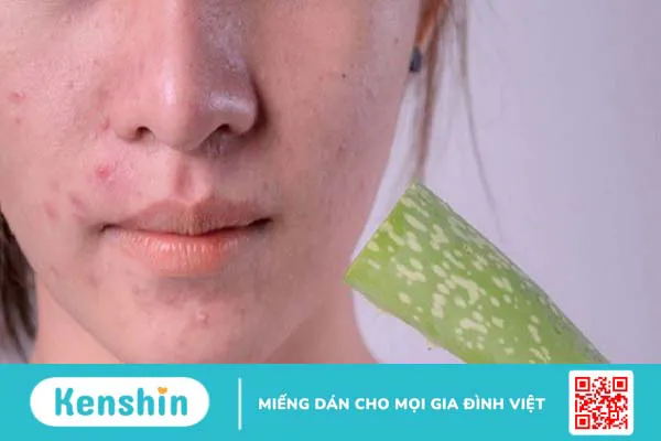 Nha đam có thể làm giảm sự xuất hiện của sẹo mụn không?