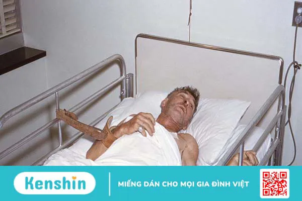 Nhận biết dấu hiệu bệnh dại theo từng giai đoạn bệnh