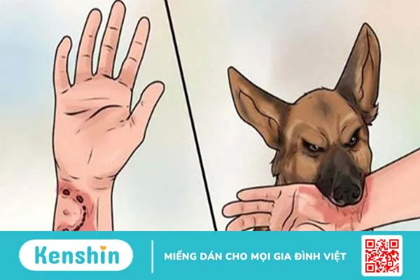 Nhận biết dấu hiệu bệnh dại theo từng giai đoạn bệnh