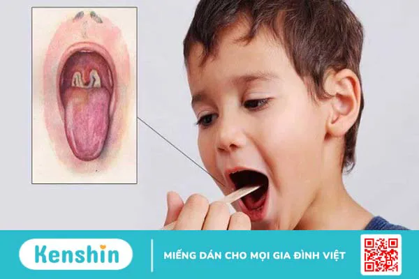 Nhận biết sớm triệu chứng bệnh bạch hầu để điều trị hiệu quả