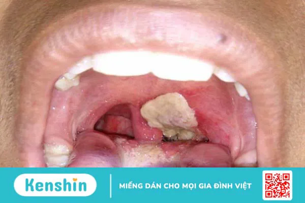 Nhận biết sớm triệu chứng bệnh bạch hầu để điều trị hiệu quả