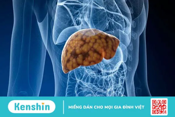 Nhiễm Covid-19 ở bệnh nhân xơ gan