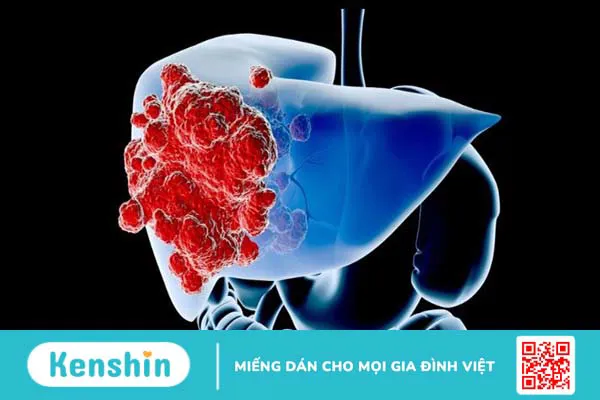 Nhiễm Covid-19 ở bệnh nhân xơ gan