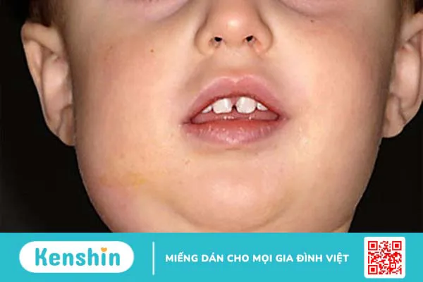 Nhiễm siêu vi là gì, nguyên nhân và cách điều trị