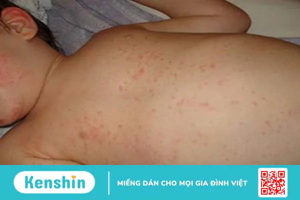 Nhiễm siêu vi là gì, nguyên nhân và cách điều trị