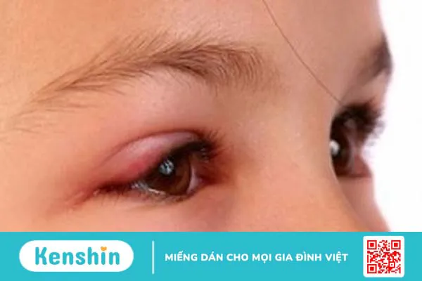 Nhiễm siêu vi là gì, nguyên nhân và cách điều trị