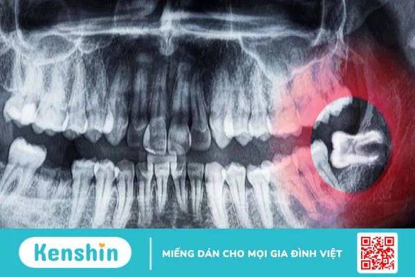 Nhổ răng khôn kiêng gì, ăn gì giúp mau lành và nhanh khỏi