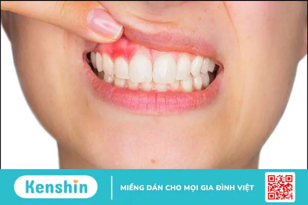 Những bệnh lây qua hôn nhau – 11 bệnh lây qua hôn nhau bạn cần lưu ý