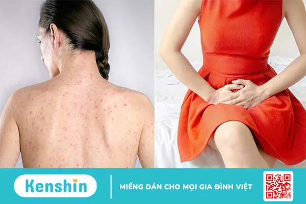 Những bệnh lây qua hôn nhau – 11 bệnh lây qua hôn nhau bạn cần lưu ý