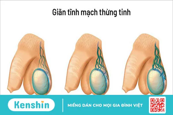 Những nguyên nhân vô sinh ở nam giới bạn không nên bỏ qua