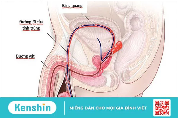 Những nguyên nhân vô sinh ở nam giới bạn không nên bỏ qua