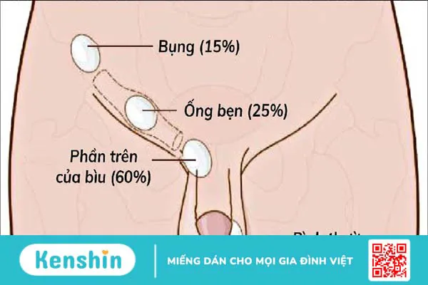 Những nguyên nhân vô sinh ở nam giới bạn không nên bỏ qua